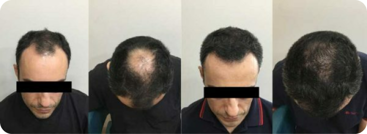 Alopecia Areata 1 Group 241