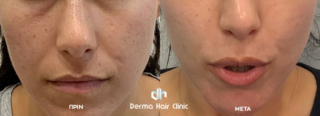 Fractional Laser 1 before after fractional