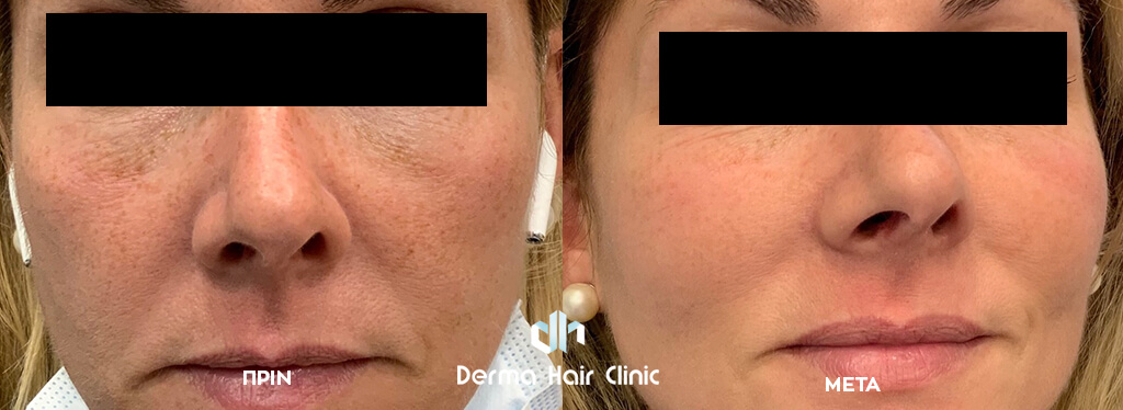 Gesichts-Dunkelflecken(Melasma) 1 before after karalexis panades2