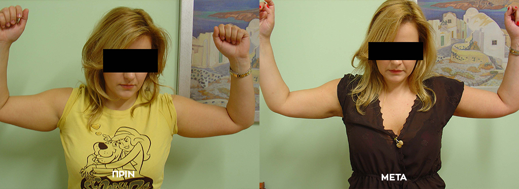 Liposuction on the Arms 1 before after