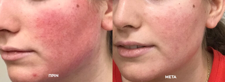 Laserbehandlung für Rosazea 1 before after