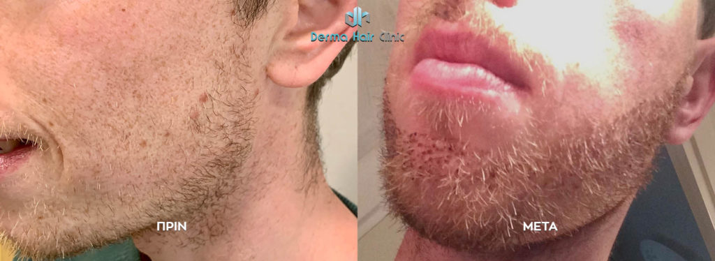 FUE Beard Transplant 2 emfuteush geniwn fue 2