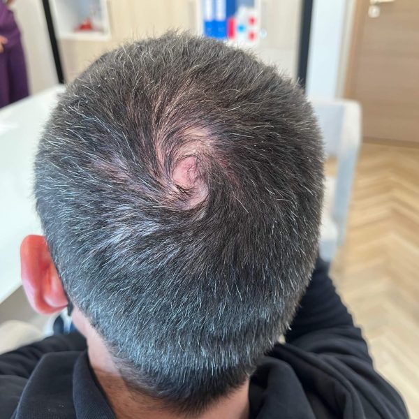 Follicular Lichen 5 3C626853 F001 4B83 BE89 DA3DE73BBEAB1 1