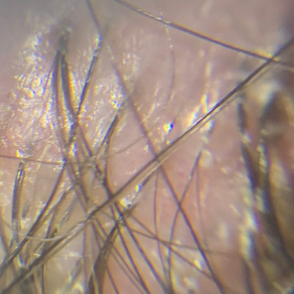Follicular Lichen 1 IMG 7492 min