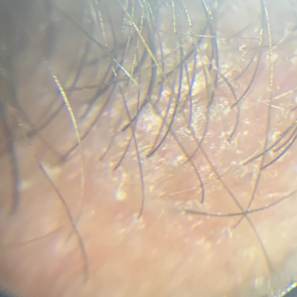 Follicular Lichen 4 IMG 8131 min