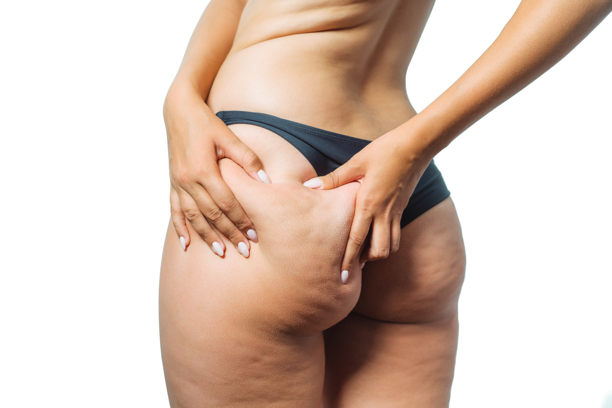 Behandlung von Cellulite 1 iStock 1180871577