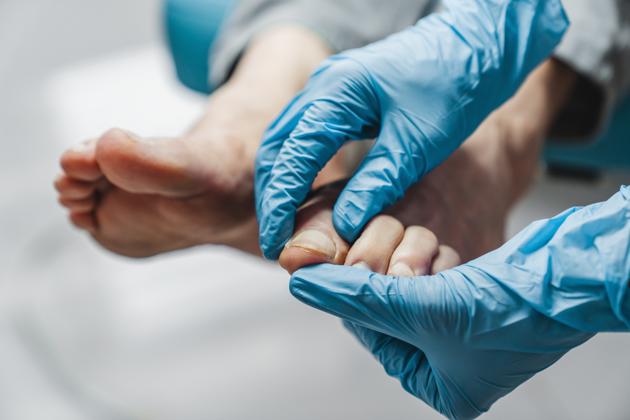 Ingrown Nail 1 iStock 1266811992