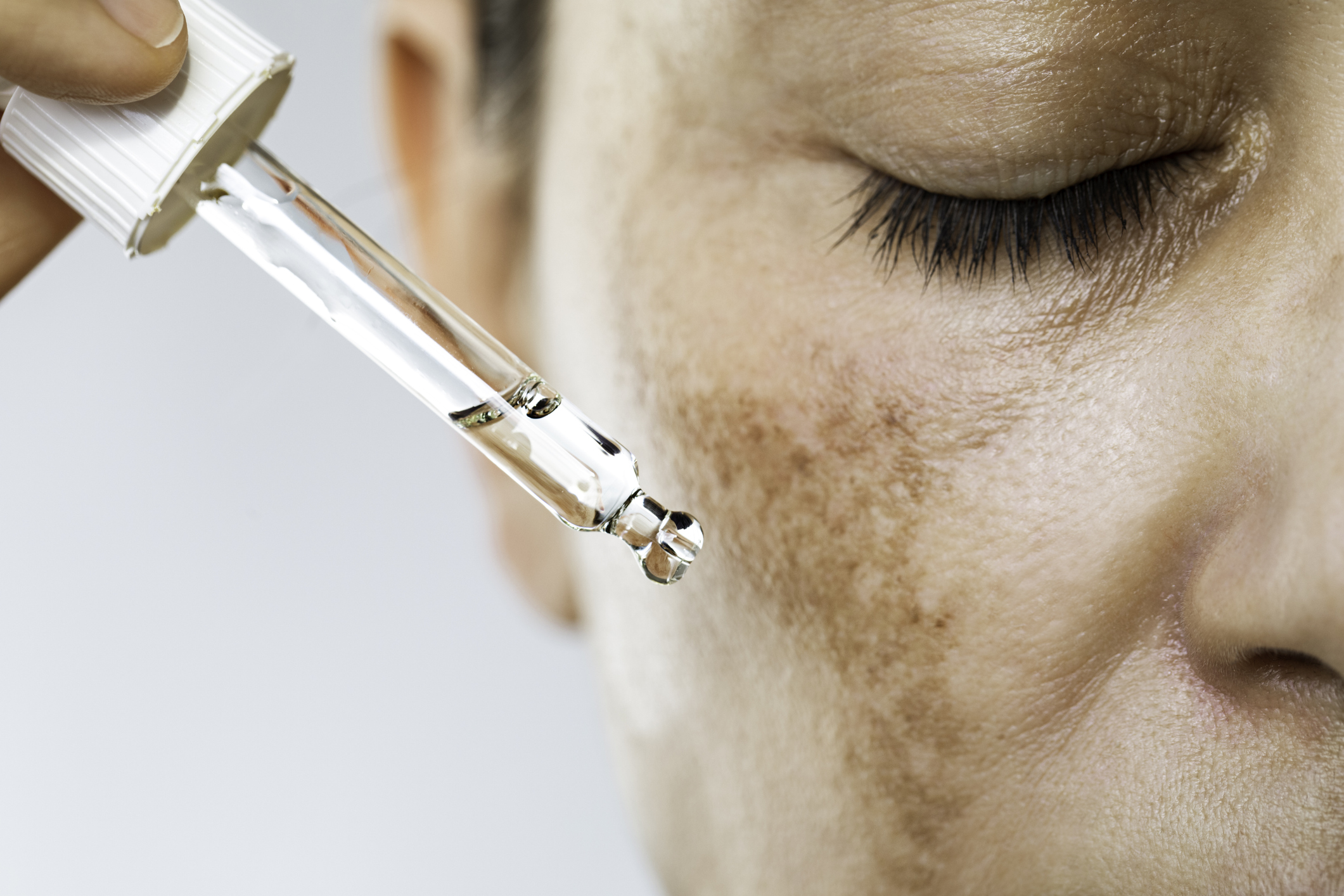 Gesichts-Dunkelflecken(Melasma) 3 iStock 1456638962