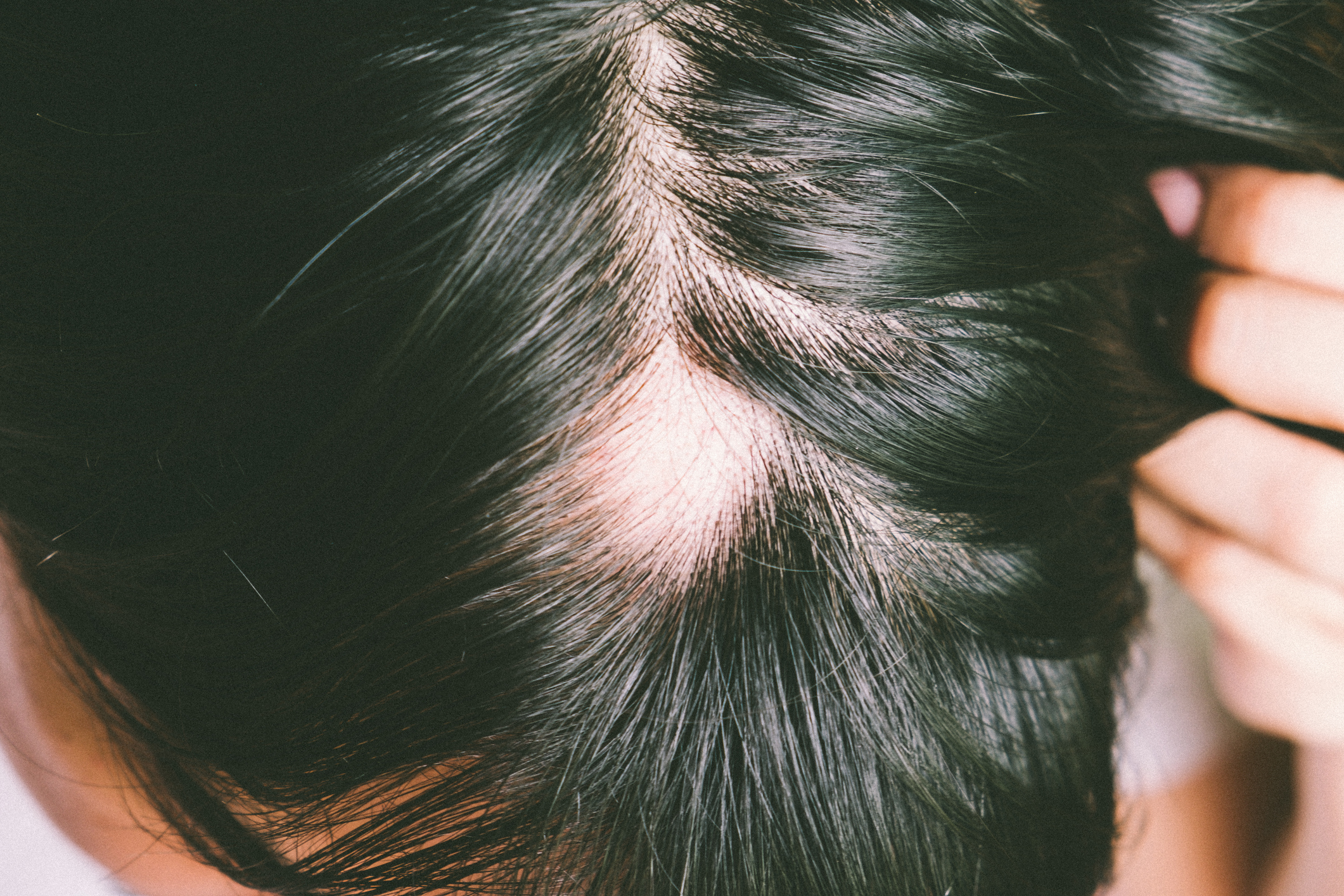 Androgene Alopezie 1 iStock 998189030