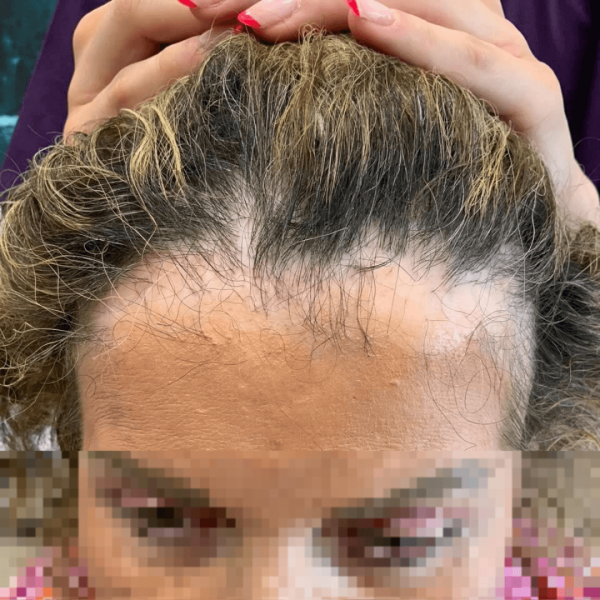 Follicular Lichen 9 λειχήνας περιαστατικά 1 1