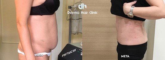 Laserliposuktion Bauch & Taille 1 prin meta koilia mesi