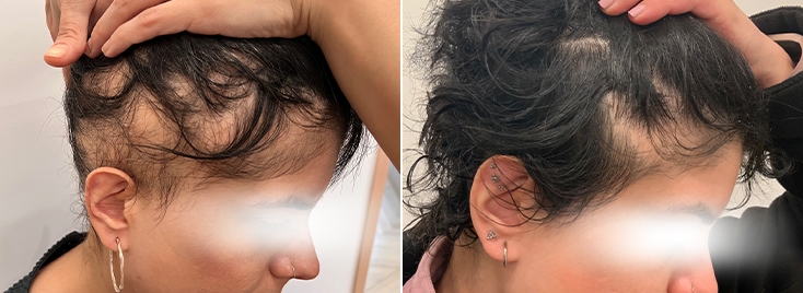 Alopecia Areata 1 alopekia 1