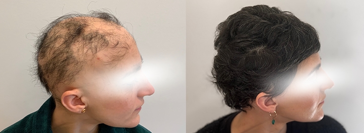 Alopecia Areata 2 alopekia 2