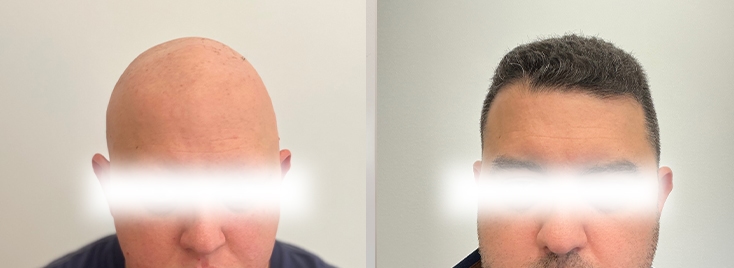 Alopecia Areata 3 alopekia 3