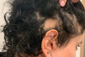 Alopecia Areata 15 γυροειδης αλωπεκια 1