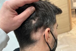 Alopecia Areata 14 γυροειδης αλωπεκια 2