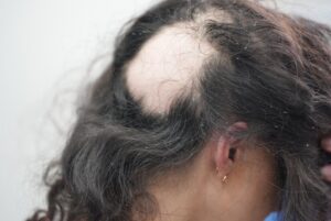 Alopecia Areata 13 γυροειδης αλωπεκια 3_2