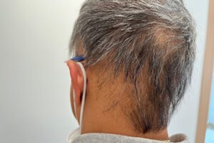 Alopecia Areata 12 γυροειδης αλωπεκια 4_2
