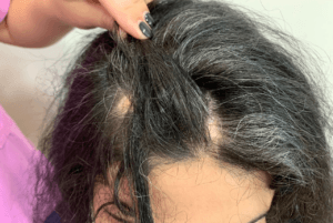 Alopecia Areata 11 γυροειδης αλωπεκια 5_2