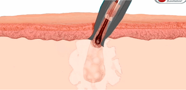 Μεταμόσχευση Μαλλιών 9 f3beca58dd363bb20cc59d81a6eec1a6 1