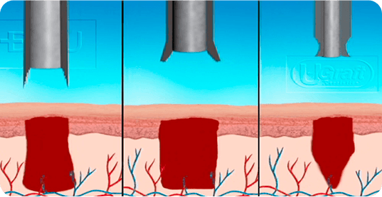 Μεταμόσχευση Μαλλιών 10 f3c022e798b79e2be5a7c713359d3693 1