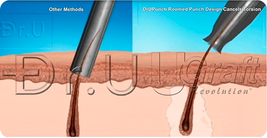Μεταμόσχευση Μαλλιών 11 karalexis ugraft 1