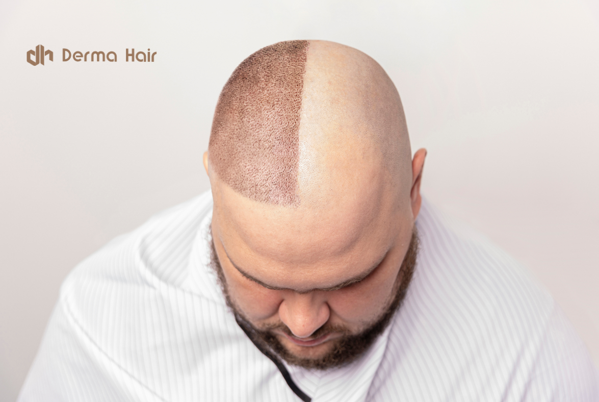 Προσθετική Μαλλιών