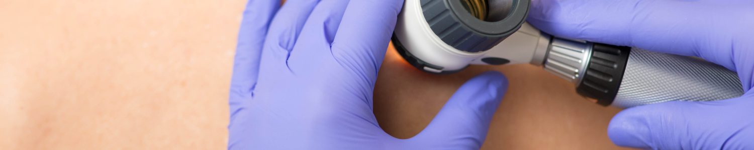 dermatologist Inspecting patient skin moles at clinic Doctor examining patient skin moles with dermoscope